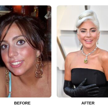 Lady Gaga Teeth Before and After: What Happened in Her Transformation?