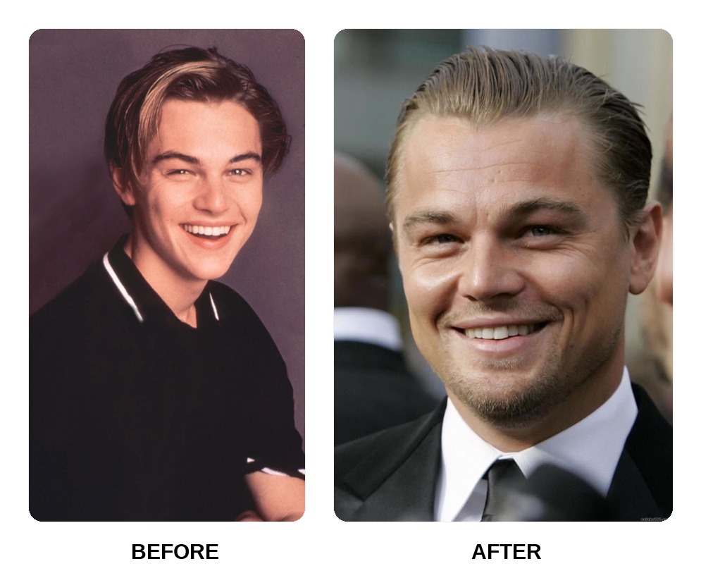 Leonardo DiCaprio Teeth Before and After: What Happened in His Transformation?