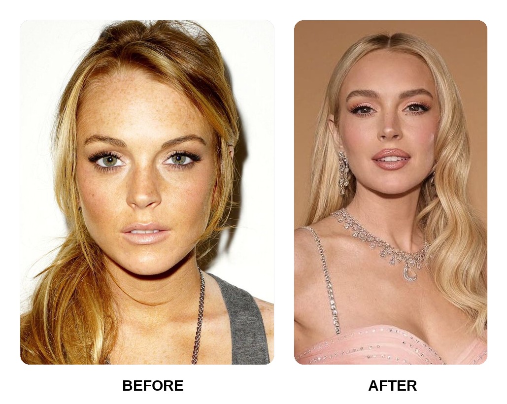 Lindsay Lohan Teeth Before and After: What Happened in Her Transformation?
