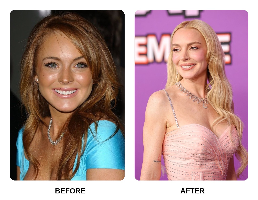 Lindsay Lohan teeth in her youth