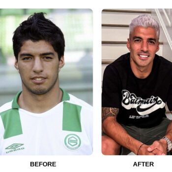 Luis Suarez Teeth Before and After: What Happened in His Transformation?