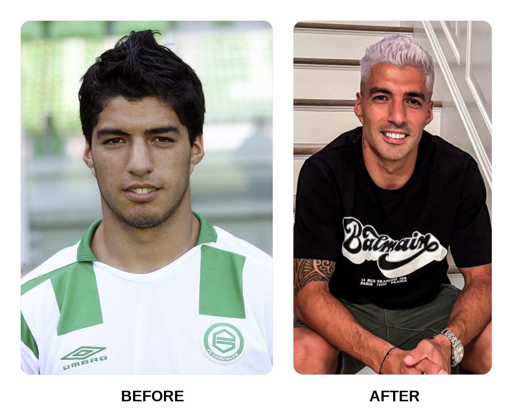 Luis Suarez Teeth Before and After: What Happened in His Transformation?