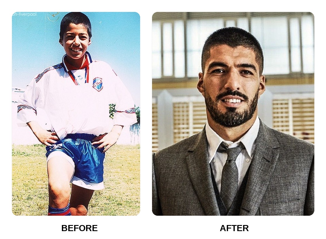 Luis Suarez teeth in his youth