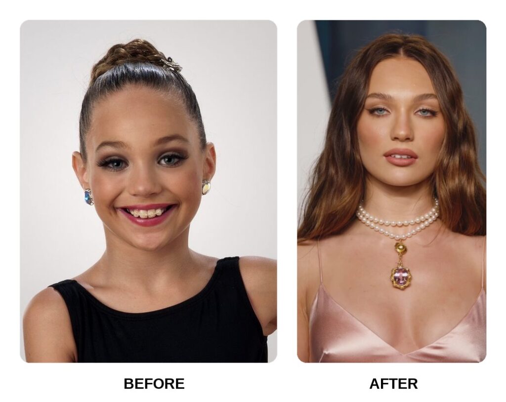 Maddie Ziegler Teeth Before and After: What Happened in Her Transformation?