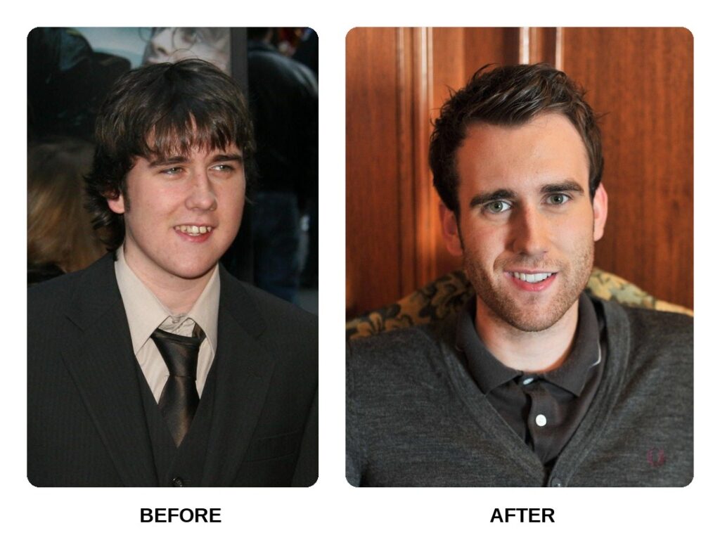Matthew Lewis Teeth Before and After: What Happened in His Transformation?