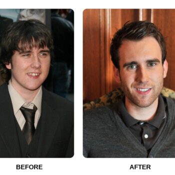 Matthew Lewis Teeth Before and After: What Happened in His Transformation?