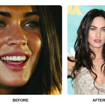 Megan Fox Teeth Before and After: What Happened in Her Transformation?