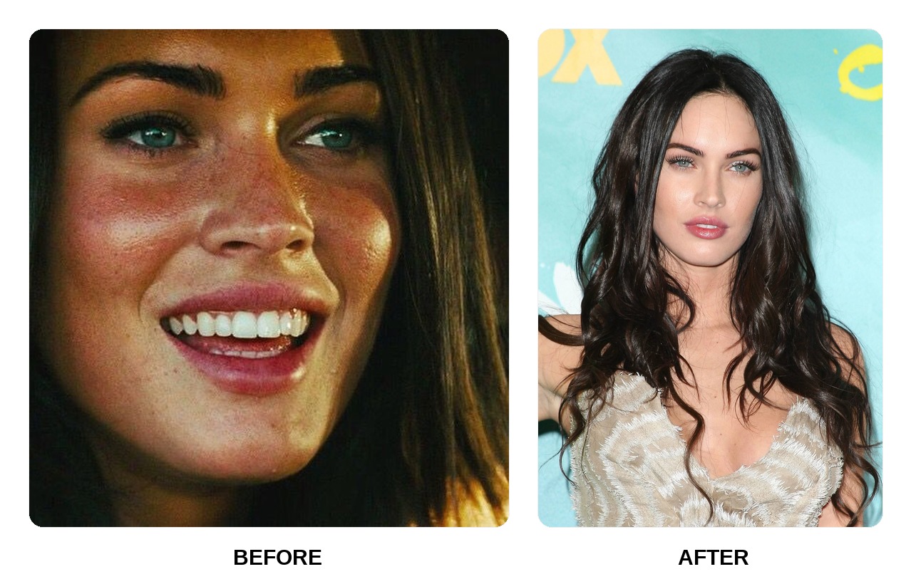 Megan Fox Teeth Before and After: What Happened in Her Transformation?