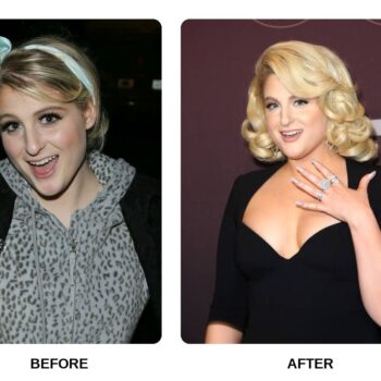 Meghan Trainor Teeth Before and After: What Happened in Her Transformation?