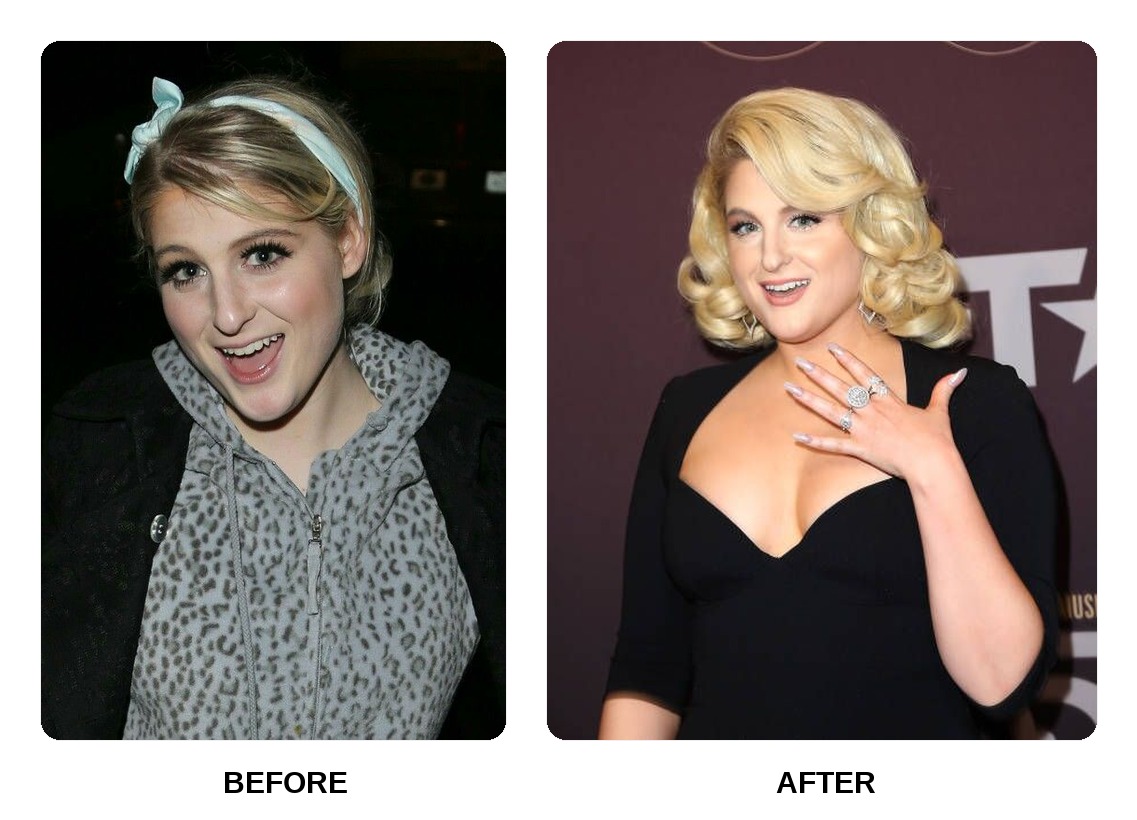 Meghan Trainor Teeth Before and After: What Happened in Her Transformation?