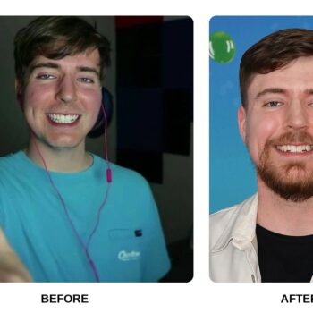 MrBeast Teeth Before and After: What Happened in His Transformation?