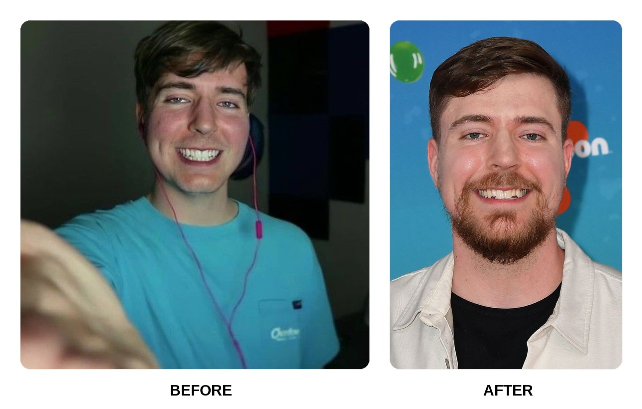 MrBeast Teeth Before and After: What Happened in His Transformation?