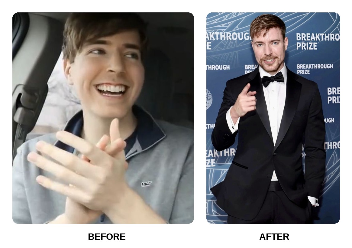 MrBeast teeth in his youth