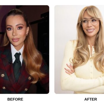 Olivia Attwood Teeth Before and After: What Happened in Her Transformation?
