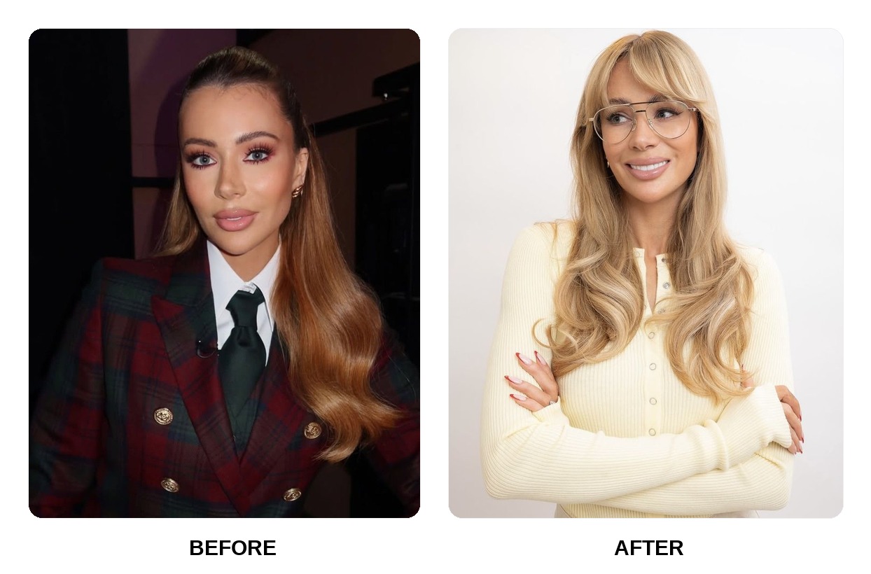 Olivia Attwood Teeth Before and After: What Happened in Her Transformation?