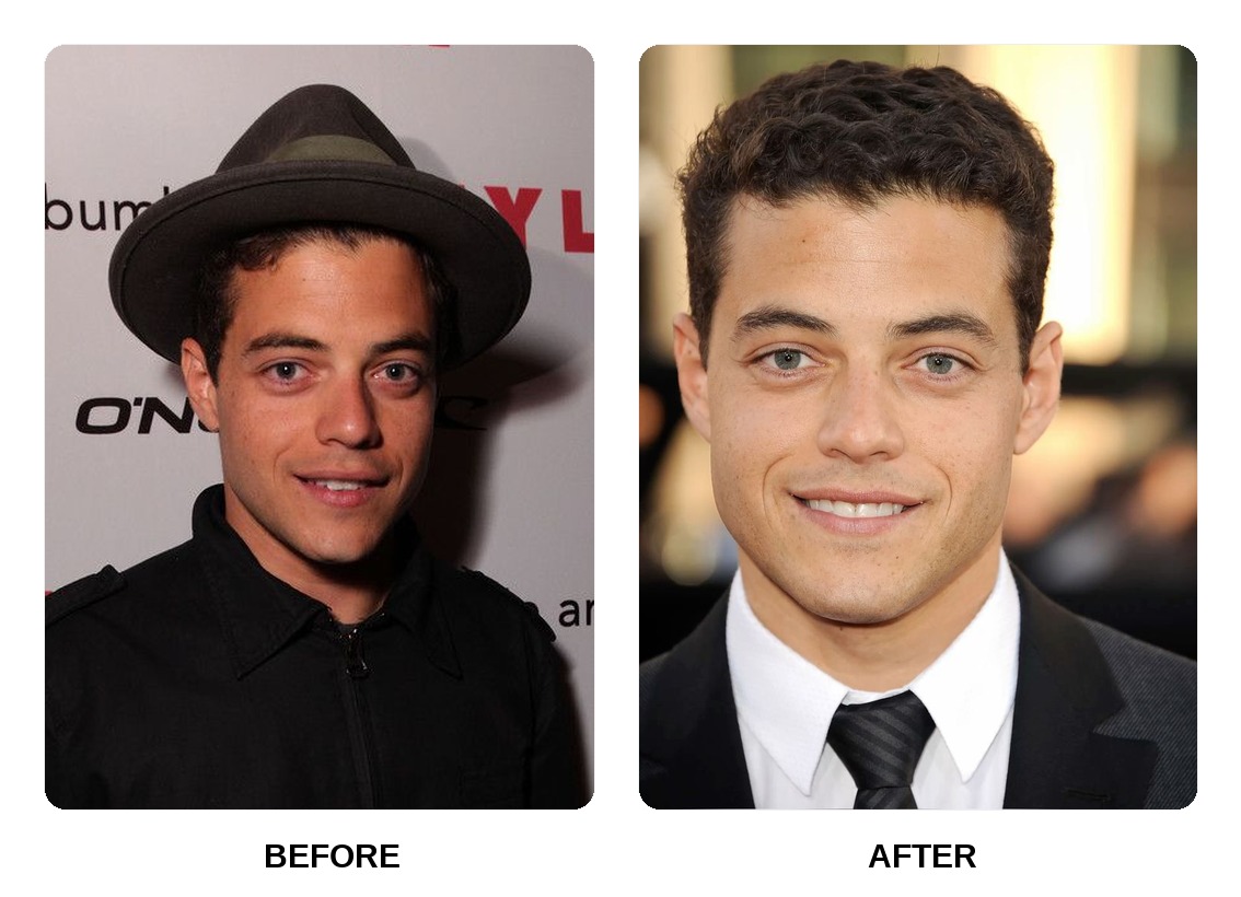 Rami Malek Teeth Before and After: What Happened in His Transformation?