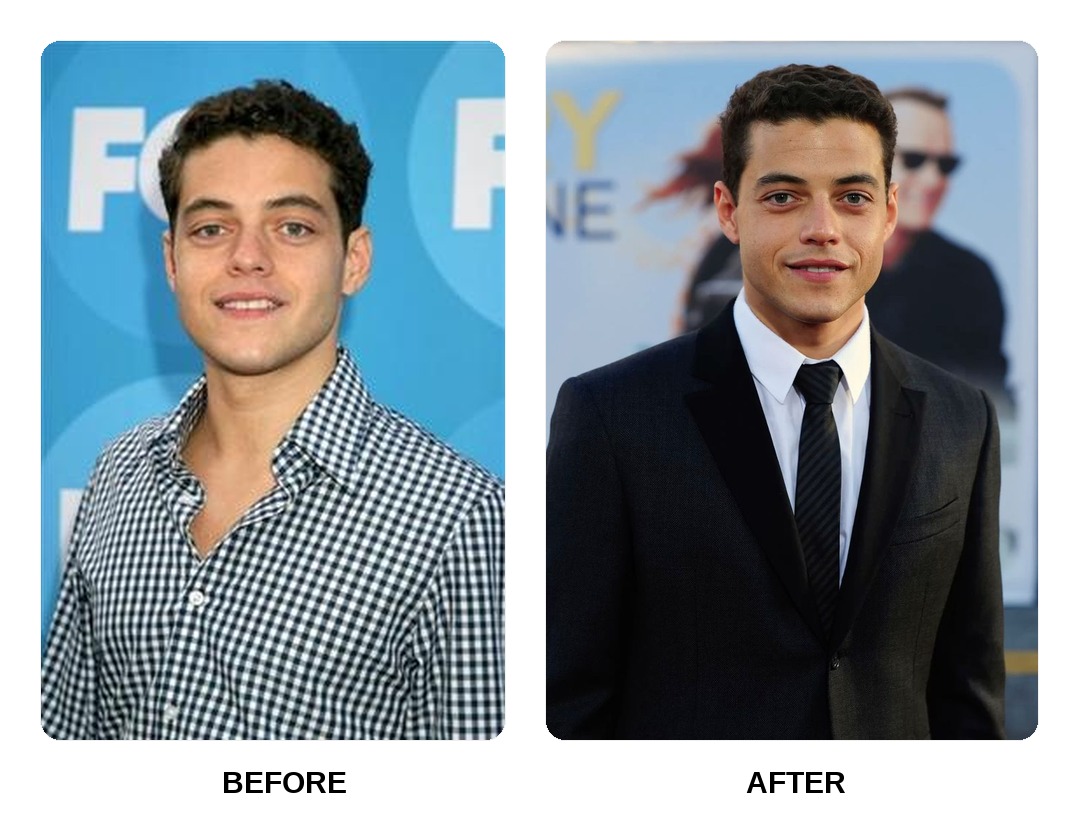 Rami Malek teeth in his youth
